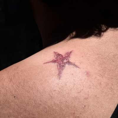 here’s a few realistic joestar birthmarks ive done recently ! i’m still doing a … — tattoo by Arika Amricachi, colton, CALIFORNIA