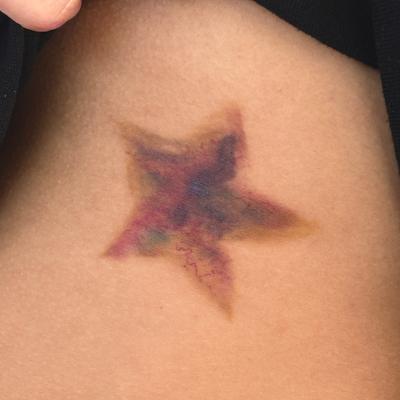 thanks @im.fatally.yours for letting me do this sick BRUISE tattoo !! — tattoo by Arika Amricachi, colton, CALIFORNIA