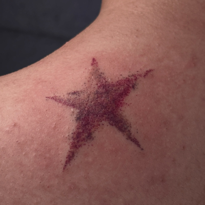 I WILL NEVER GET TIRED OF STAR BIRTHMARKS (OR REALLY ANY BIRTHMARK TATTOOS) ~
vi… — tattoo by Arika Amricachi, colton, CALIFORNIA